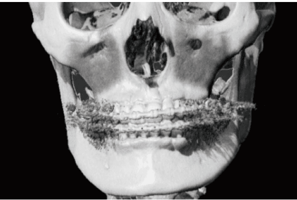 医療3Dモデルのノイズ除去事例